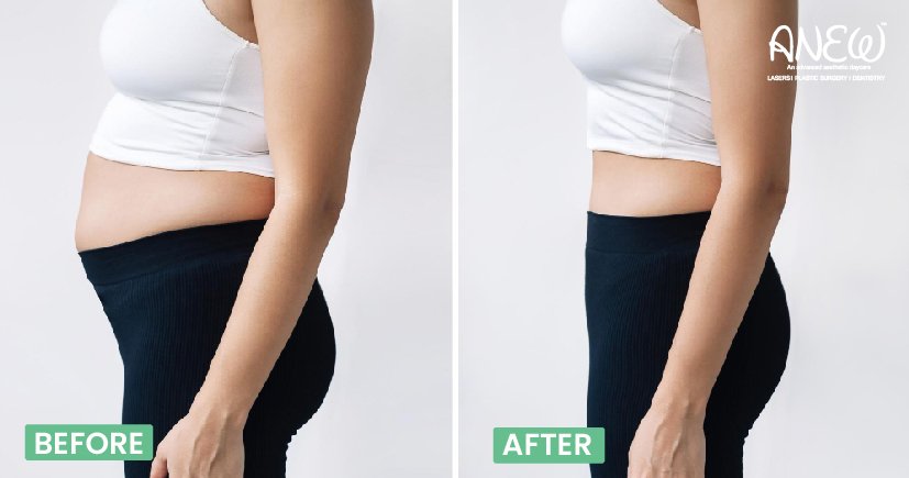 Tummy tuck surgery in Bangalore 